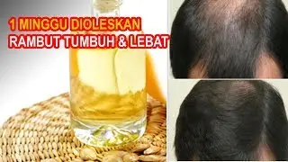 Oleskan Ini Semiggu Rambut Rontok Tumbuh Kembali