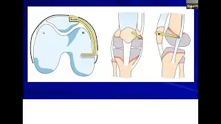 Patellar Instability in Adolescents and MPFL Reconstruction: Shital Parikh MD