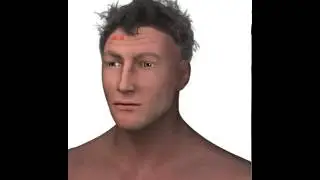 Botox Dr.Mustafa Karataş