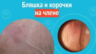 🤔 Бляшка и корочки на члене. Клинический случай №1194