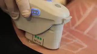 Ultherapy Dekolte