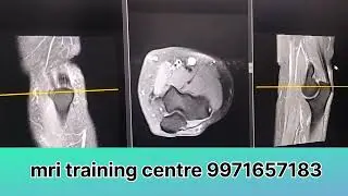 MRI ELBOW TENDON ANATOMY