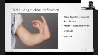 Congenital deformities of the Upper Limb