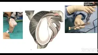 Anterior Glenoid Bone Loss in Shoulder Instability