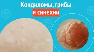 😲 Кондиломы, грибы и синехии. Клинический случай №1193