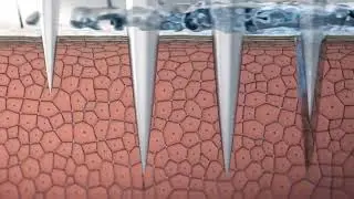 AQUAPURE II