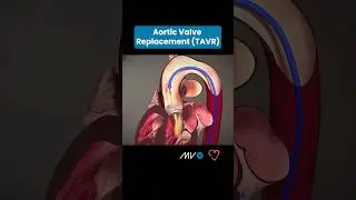 🫀Transcatheter Aortic Valve Replacement (TAVR) 🫀