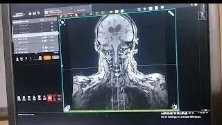 MRI WHOLE SPINE
