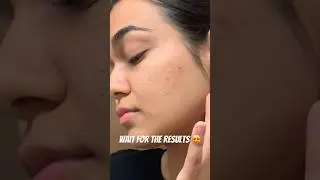 ACNE SCARS TREATMENT 