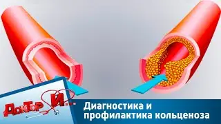 Диагностика и профилактика кольценоза | Доктор И