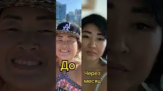 Блефаропластика/сангапури/до и после