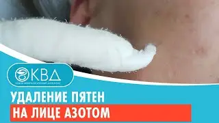 ✅ Удаление пятен на лице азотом. Клинический случай №473