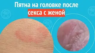 😬 Пятна на головке после секса с женой. Клинический случай №1207