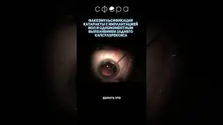 Факоэмульсификация катаракты с имплантацией ИОЛ и одномоментным выполнением заднего капсулорексиса