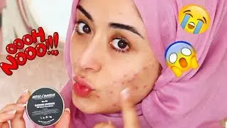Cover Acne Spots FAST!!!  Hide Spot In 1 Minute ZUKREAT