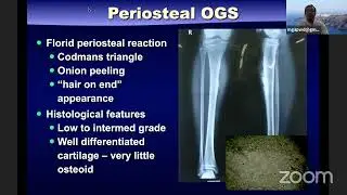Osteosarcoma- Current Concepts