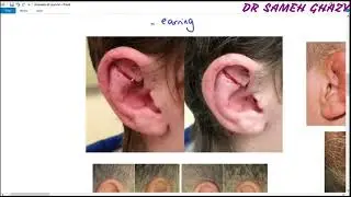 ENT 11 : diseases of auricle  ( trauma and perichondritis ) DR SAMEH GHAZY
