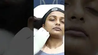 Get rid of skin aging, skin laxity, tiredness & skin dullness with Profhilo Treatment | 