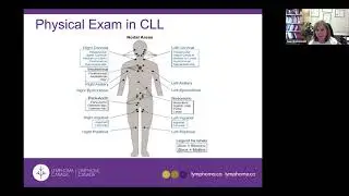 Chronic Lymphocytic Leukemia