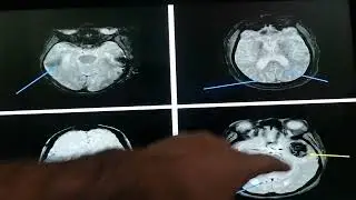 Blood appearance on mri GE and Siemens