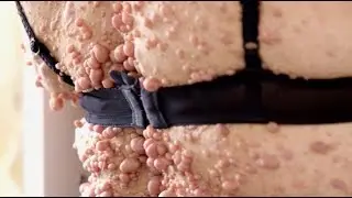 La neurofibromatose de Rachel - S.O.S Dermato