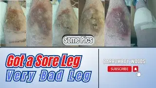 Got a Sore Leg 🦵 Very Bad Leg Some Pics