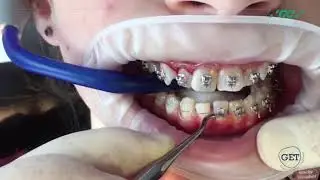 Установка брекетов Experience от GC Orthodontics