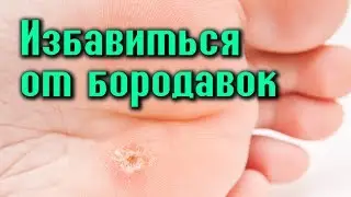 КАК ИЗБАВИТЬСЯ ОТ БОРОДАВОК В ДОМАШНИХ УСЛОВИЯХ