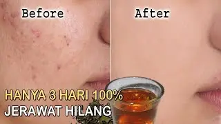 INSYAALLAH Dalam 3 Hari Jerawat Sembuh Wajah Jadi Bersih Bersinar
