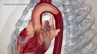 UW using new non-invasive heart valve replacement procedure