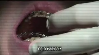 Снятие брекетов Experience metal