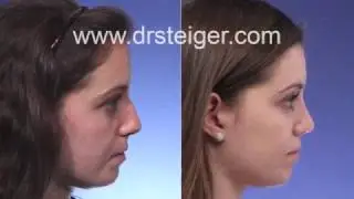 Dr Steiger Rhinoplasty Review