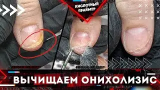 Снова онихолизис ногтей??😱 Отслоение ногтя😵 Подробно! Белые пятна на ногтях, зачищаем!