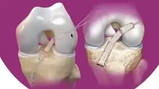ACL Reconstruction- Surgical Pearls