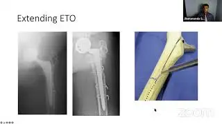 Complex Revision Hip Arthroplasty