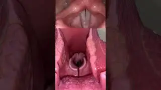Live view of the vocal cords! 