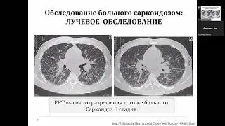 Саркоидоз. Современное состояние проблемы. Вопросы диагностики
