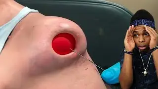a ball got stuck in his arm..