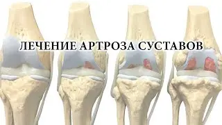 КАК ЛЕЧИТЬ АРТРОЗ?! Инъекции, физиолечение, операция или менять сустав - мнение эксперта.
