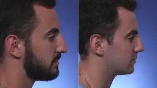 Palm Beach Rhinoplasty - Dr. Steiger Reviews