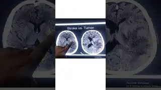 Brain pathology