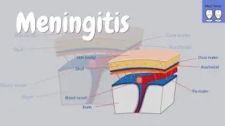 Meningitis [bacterial vs viral, symptoms, Kernig's sign, clinical clues, meningococcal infection]