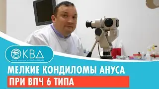 😲 Мелкие кондиломы ануса при ВПЧ 6 типа. Клинический случай №746