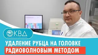 ✅ Удаление рубца на головке радиоволновым методом. Клинический случай №421