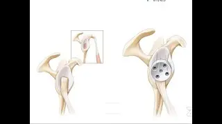 Glenoid Reconstruction Options in Shoulder Arthroplasty