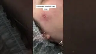 удаление жировика на лице