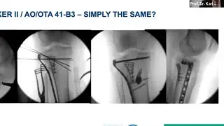 Tibial Plateau fractures