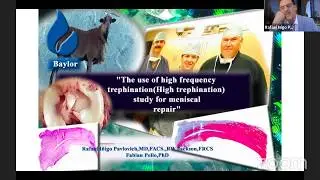 Meniscal Repair using RadioFrequency