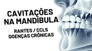 Cavitação Osteonecrótica NICO Lechner