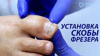 Лечение вросшего ногтя БЕЗ ХИРУРГИИ и БОЛИ